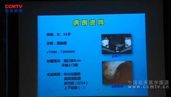 王志国：腹腔镜直肠癌根治术（含讲解）